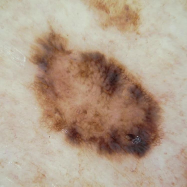 Melanoma